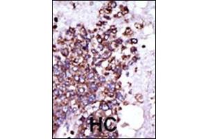 Formalin-fixed and paraffin-embedded human cancer tissue reacted with the primary antibody, which was peroxidase-conjugated to the secondary antibody, followed by DAB staining. (CAMK1 抗体  (C-Term))