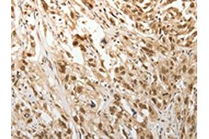 The image on the left is immunohistochemistry of paraffin-embedded Human esophagus cancer tissue using ABIN7189683(ADIPOR2 Antibody) at dilution 1/15, on the right is treated with synthetic peptide. (Adiponectin Receptor 2 抗体)