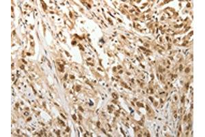 The image on the left is immunohistochemistry of paraffin-embedded Human esophagus cancer tissue using ABIN7189683(ADIPOR2 Antibody) at dilution 1/15, on the right is treated with synthetic peptide. (Adiponectin Receptor 2 抗体)