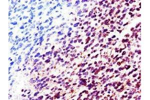 Immunohistochemistry of paraffin-embedded human glioma using ABIN7157858 at dilution of 1:100 (Lamin B2 抗体  (AA 442-615))