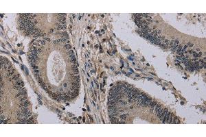 Immunohistochemistry of paraffin-embedded Human colon cancer using HIST1H2AH Polyclonal Antibody at dilution of 1:40 (HIST1H2AH 抗体)