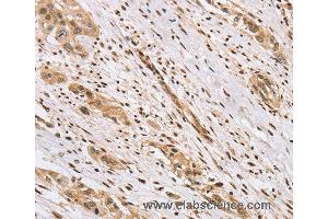 Immunohistochemistry of Human esophagus cancer using CENPV Polyclonal Antibody at dilution of 1:40 (CENPV 抗体)