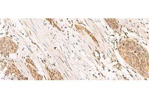 Immunohistochemistry of paraffin-embedded Human esophagus cancer tissue using POP4 Polyclonal Antibody at dilution of 1:65(x200) (RPP29 抗体)