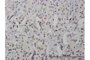 Immunoperoxidase of monoclonal antibody to RNF168 on formalin-fixed paraffin-embedded human prostate cancer. (RNF168 抗体  (AA 462-571))