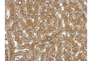 IHC-P Image Immunohistochemical analysis of paraffin-embedded human hepatoma, using NDST3, antibody at 1:500 dilution. (NDST3 抗体  (Center))