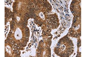 The image on the left is immunohistochemistry of paraffin-embedded Human colon cancer tissue using ABIN7129394(ERCC6L Antibody) at dilution 1/30, on the right is treated with fusion protein. (ERCC6L 抗体)