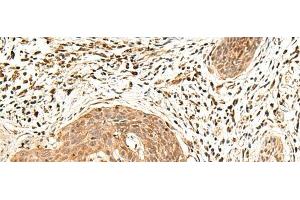 Immunohistochemistry of paraffin-embedded Human esophagus cancer tissue using LDHA Polyclonal Antibody at dilution of 1:25(x200)