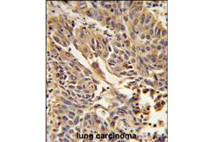 Formalin-fixed and paraffin-embedded human lung carcinoma reacted with JUP Antibody , which was peroxidase-conjugated to the secondary antibody, followed by DAB staining. (JUP 抗体  (C-Term))