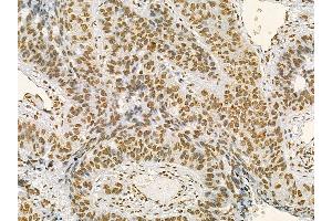 HNRPA3 Mouse Monoclonal Antibody at 1/100 staining human lung cancer and adjacent non-tumor tissue by IHC-P.