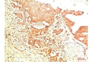 Immunohistochemical analysis of paraffin-embedded Human Breast Carcinoma Tissue using Acetyl P53(K382) Mouse mAb diluted at 1:200. (p53 抗体  (acLys382))