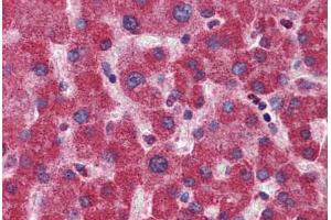 Immunohistochemistry (Formalin-fixed Paraffin-embedded Sections) (IHC (fp)) image for anti-Methylenetetrahydrofolate Dehydrogenase (NADP+ Dependent) 1, Methenyltetrahydrofolate Cyclohydrolase, Formyltetrahydrofolate Synthetase (MTHFD1) (AA 863-912) antibody (ABIN6747103)