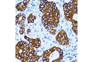 Immunohistochemistry of paraffin-embedded human gastric cancer using Cathepsin E (CTSE) antibody (ABIN3016440, ABIN3016441, ABIN3016442 and ABIN6219747) at dilution of 1:100 (40x lens). (Cathepsin E 抗体)