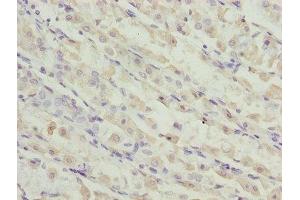 Immunohistochemistry of paraffin-embedded human gastric cancer using ABIN7173119 at dilution of 1:100 (TMEM19 抗体  (AA 105-217))