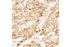 Immunohistochemistry of paraffin-embedded human liver cancer using PFKP antibody (ABIN7269309) at dilution of 1:100 (40x lens). (PFKP 抗体)