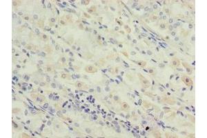 Immunohistochemistry of paraffin-embedded human gastric cancer using ABIN7142334 at dilution of 1:100 (OXSM 抗体  (AA 78-345))