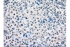 Immunohistochemical staining of paraffin-embedded Adenocarcinoma of ovary tissue using anti-MAPK1mouse monoclonal antibody. (ERK2 抗体)
