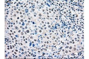 Immunohistochemical staining of paraffin-embedded Adenocarcinoma of ovary tissue using anti-MAPK1mouse monoclonal antibody.
