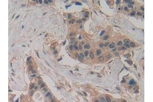Detection of Slit2 in Human Breast cancer Tissue using Polyclonal Antibody to Slit Homolog 2 (Slit2) (SLIT2 抗体  (AA 1416-1528))