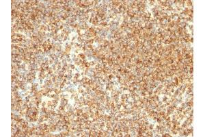 Formalin-fixed, paraffin-embedded human Lymphoma stained with CD20 Mouse Monoclonal Antibody (L26). (CD20 抗体)