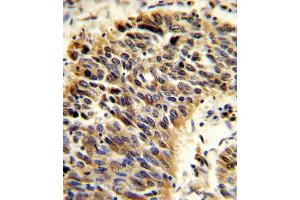 Formalin-fixed and paraffin-embedded human lung carcinoma reacted with VTN Antibody (N-term), which was peroxidase-conjugated to the secondary antibody, followed by DAB staining.