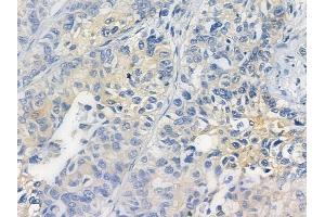 ABIN6256802 and ABIN6267299 at 1/100 staining human lung squamous cell carcinoma by IHC-P.