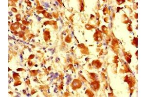 Immunohistochemistry of paraffin-embedded human melanoma using ABIN7163108 at dilution of 1:100 (CDS1 抗体  (AA 6-85))