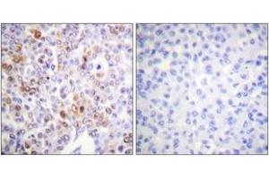 Immunohistochemistry analysis of paraffin-embedded human breast carcinoma tissue, using Histone H4 (Acetyl-Lys16) Antibody. (Histone H4 抗体  (acLys16))