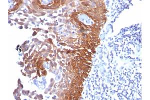 Formalin-fixed, paraffin-embedded human Cervical Carcinoma stained with CK17 Mouse Monoclonal Antibody (E3). (KRT17 抗体)