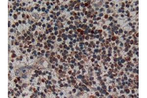 Detection of CRF in Human Skin cancer Tissue using Polyclonal Antibody to Corticotropin Releasing Factor (CRF) (CRH 抗体  (AA 40-195))