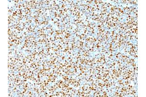 Formalin-fixed, paraffin-embedded human Mantle Cell Lymphoma stained with Cyclin D1 Mouse Monoclonal Antibody (DCS-6). (Cyclin D1 抗体)
