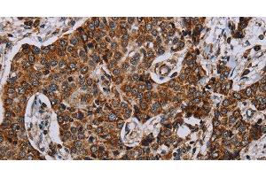 Immunohistochemistry of paraffin-embedded Human liver cancer using NDUFA4 Polyclonal Antibody at dilution of 1:40 (NDUFA4 抗体)