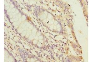 Immunohistochemistry of paraffin-embedded human colon cancer using ABIN7169258 at dilution of 1:100 (PPP2R5C 抗体  (Regulatory Subunit Gamma))