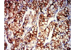 Immunohistochemical analysis of paraffin-embedded renal cancer tissues using CD203C mouse mAb with DAB staining. (ENPP3 抗体  (AA 45-163))
