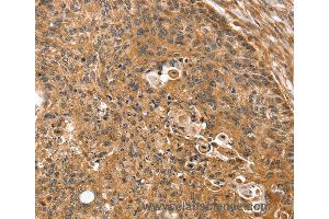 Immunohistochemistry of Human breast cancer using SSX2IP Polyclonal Antibody at dilution of 1:35 (SSX2IP 抗体)