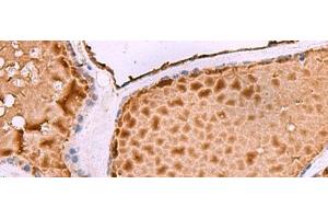 Immunohistochemistry of paraffin-embedded Human thyroid cancer tissue using ASTE1 Polyclonal Antibody at dilution of 1:50(x200) (ASTE1 抗体)