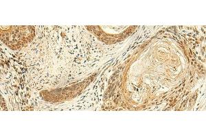 Immunohistochemistry of paraffin-embedded Human esophagus cancer tissue using ARL4D Polyclonal Antibody at dilution of 1:50(x200) (ARL4D 抗体)