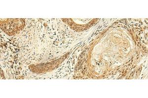Immunohistochemistry of paraffin-embedded Human esophagus cancer tissue using ARL4D Polyclonal Antibody at dilution of 1:50(x200) (ARL4D 抗体)