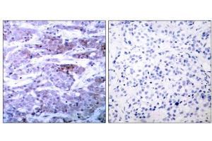 Immunohistochemical analysis of paraffin- embedded human breast carcinoma tissue using BAD (Ab-112) antibody (E021062). (BAD 抗体)