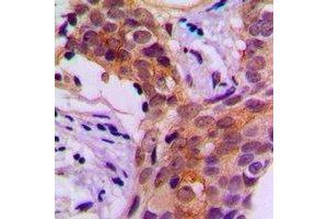 Immunohistochemical analysis of Beta-actin staining in human prostate cancer formalin fixed paraffin embedded tissue section. (beta Actin 抗体)
