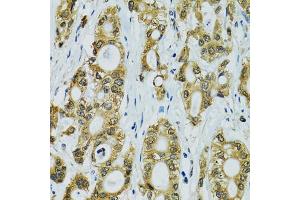 Immunohistochemistry of paraffin-embedded human rectal cancer using RPS7 antibody. (RPS7 抗体)