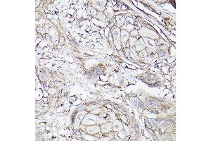 Immunohistochemistry of paraffin-embedded human esophageal cancer using MCT4/SLC16 Rabbit pAb (ABIN6129472, ABIN6147859, ABIN6147860 and ABIN6214836) at dilution of 1:100 (40x lens). (SLC16A3 抗体  (AA 371-465))