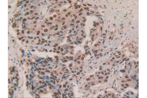 IHC-P analysis of Human Breast Cancer Tissue, with DAB staining.