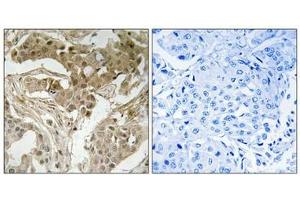 Immunohistochemical analysis of paraffin-embedded human breast carcinoma tissue using FOS (Phospho-Thr232) antibody (left)or the same antibody preincubated with blocking peptide (right). (c-FOS 抗体  (pThr232))
