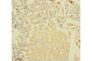 Immunohistochemistry of paraffin-embedded human lung cancer using ABIN7160909 at dilution of 1:100
