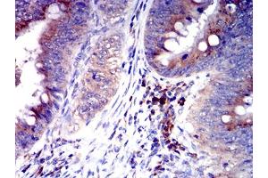 Immunohistochemical analysis of paraffin-embedded rectum cancer tissues using CD327 mouse mAb with DAB staining. (SIGLEC6 抗体  (AA 27-347))