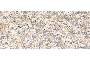 Immunohistochemistry of paraffin-embedded Human liver cancer tissue using LRRC28 Polyclonal Antibody at dilution of 1:60(x200) (LRRC28 抗体)