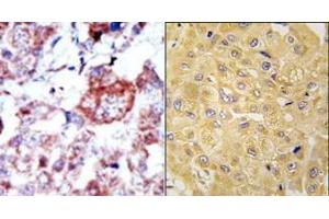 (LEFT)Formalin-fixed and paraffin-embedded human cancer tissue reacted with the primary antibody, which was peroxidase-conjugated to the secondary antibody, followed by AEC staining. (ILK 抗体  (N-Term))