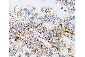 Immunohistochemistry of paraffin-embedded Human gastric cancer using PDYN Polyclonal Antibody at dilution of 1:100 (40x lens). (PDYN 抗体)
