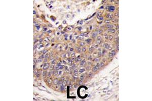Formalin-fixed and paraffin-embedded human lung carcinoma tissue reacted with FXN polyclonal antibody  , which was peroxidase-conjugated to the secondary antibody, followed by DAB staining. (Frataxin 抗体  (C-Term))