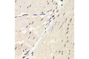 Immunohistochemistry of paraffin-embedded human gastric cancer using XRCC6 Antibody.